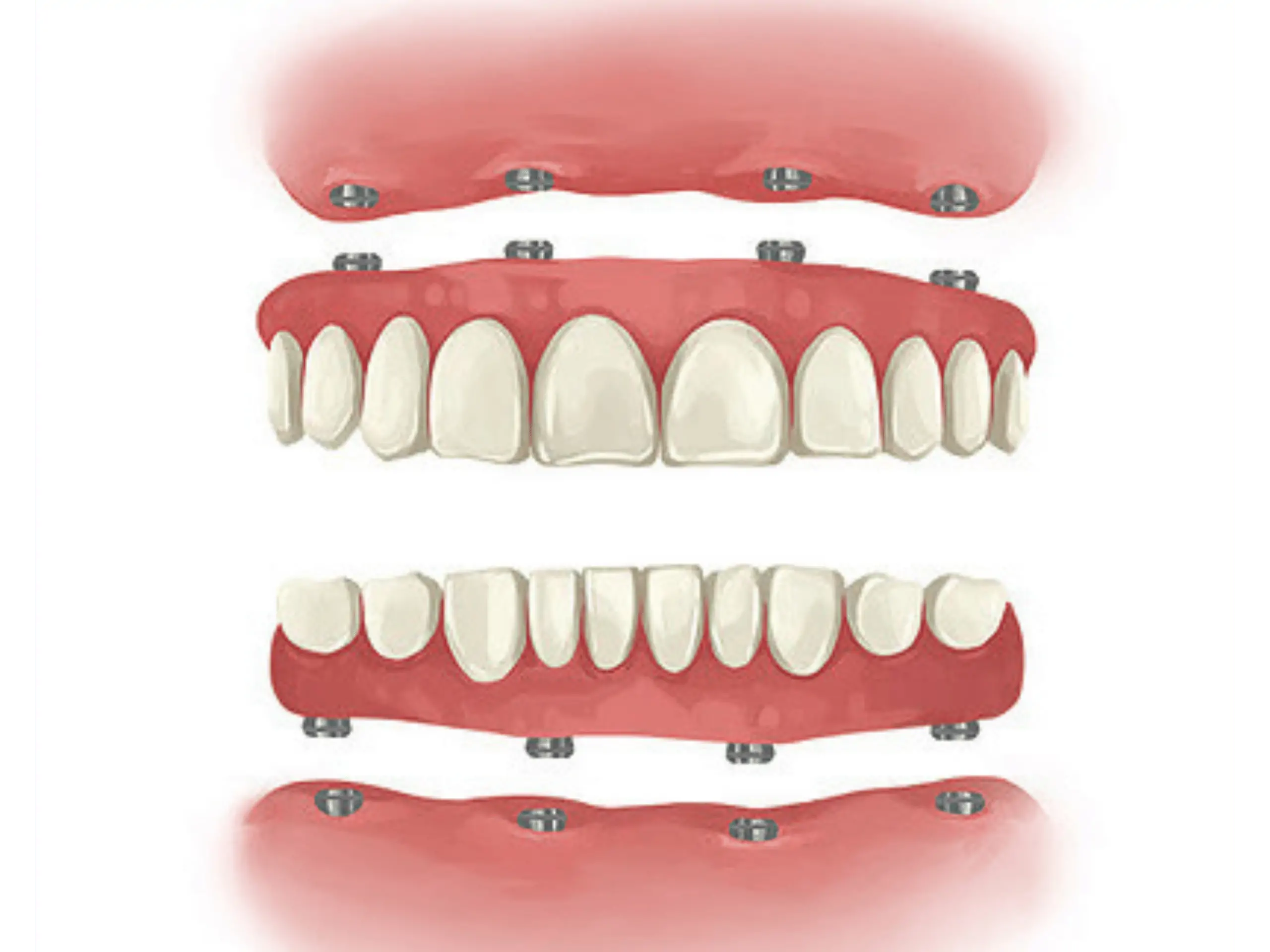 types of dental implants cost